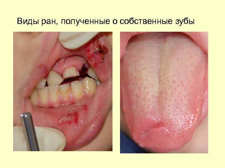 Виды ран, полученные о собственные зубы 