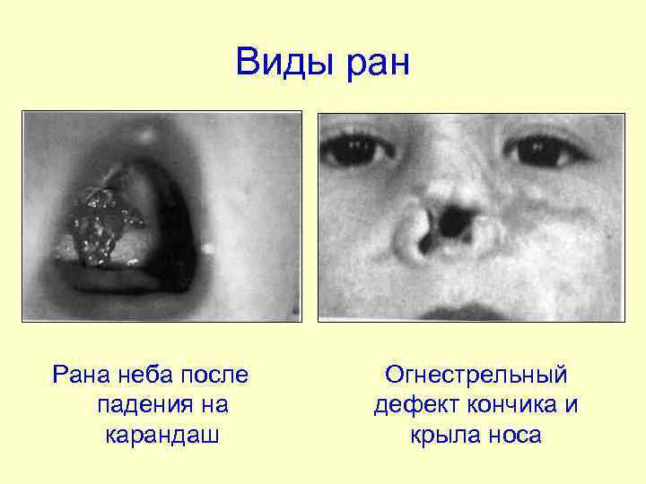 Виды ран Рана неба после падения на карандаш Огнестрельный дефект кончика и крыла носа