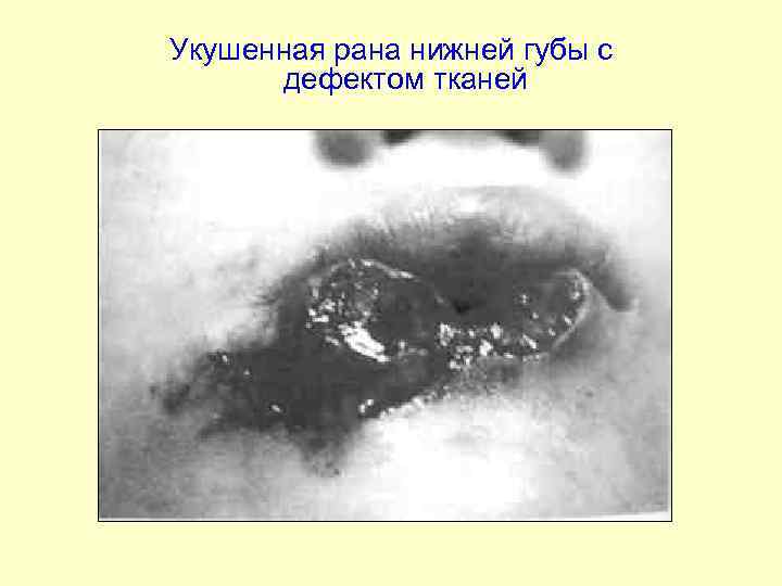 Укушенная рана нижней губы с дефектом тканей 