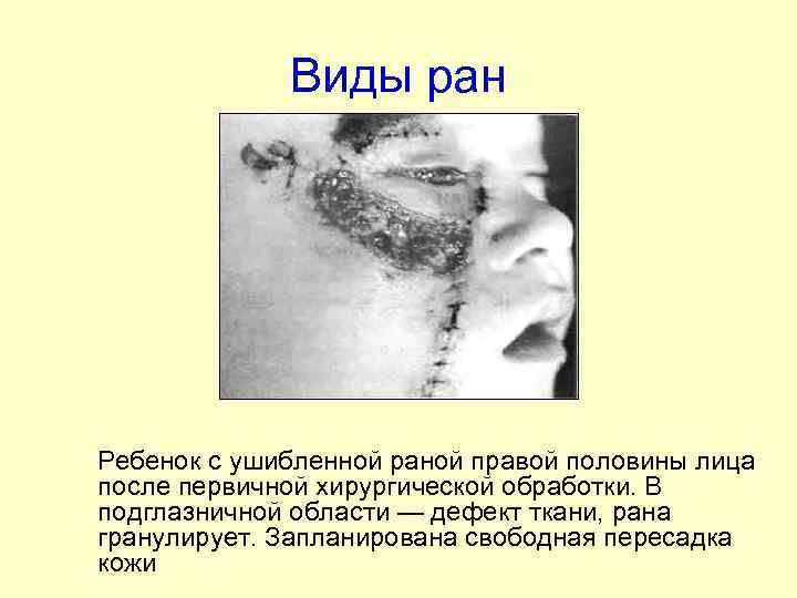 Виды ран Ребенок с ушибленной раной правой половины лица после первичной хирургической обработки. В