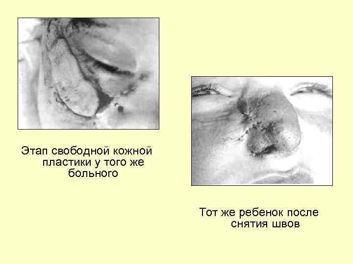 Этап свободной кожной пластики у того же больного Тот же ребенок после снятия швов