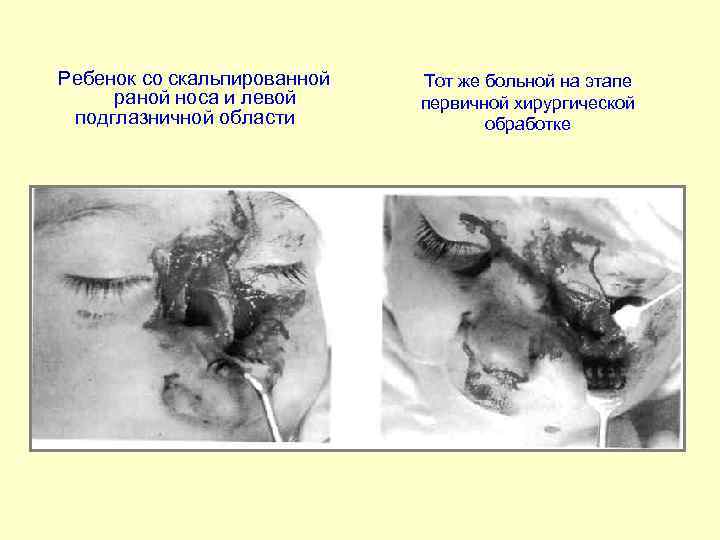 Ребенок со скальпированной раной носа и левой подглазничной области Тот же больной на этапе