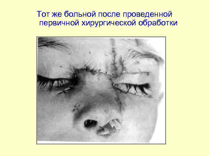 Тот же больной после проведенной первичной хирургической обработки 