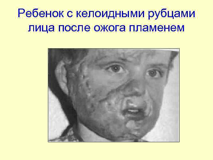 Ребенок с келоидными рубцами лица после ожога пламенем 