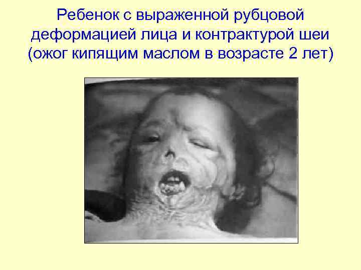 Ребенок с выраженной рубцовой деформацией лица и контрактурой шеи (ожог кипящим маслом в возрасте