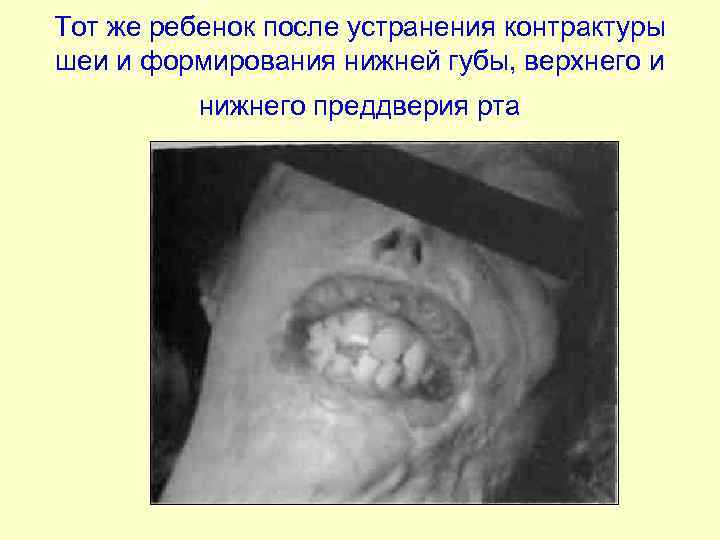 Тот же ребенок после устранения контрактуры шеи и формирования нижней губы, верхнего и нижнего