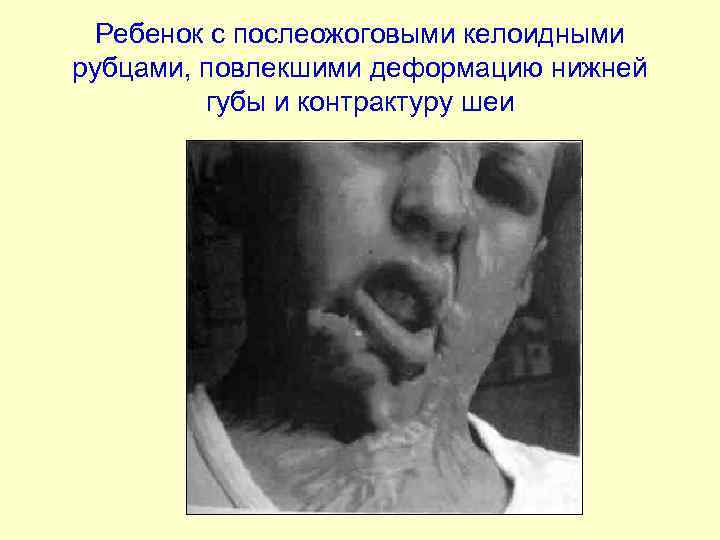 Ребенок с послеожоговыми келоидными рубцами, повлекшими деформацию нижней губы и контрактуру шеи 