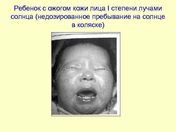 Ребенок с ожогом кожи лица I степени лучами солнца (недозированное пребывание на солнце в