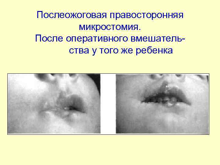 Послеожоговая правосторонняя микростомия. После оперативного вмешательства у того же ребенка 