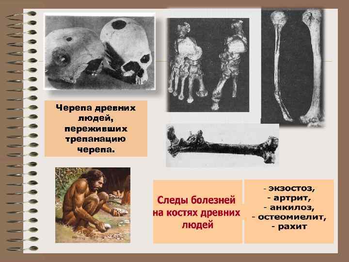Черепа древних людей, переживших трепанацию черепа. 