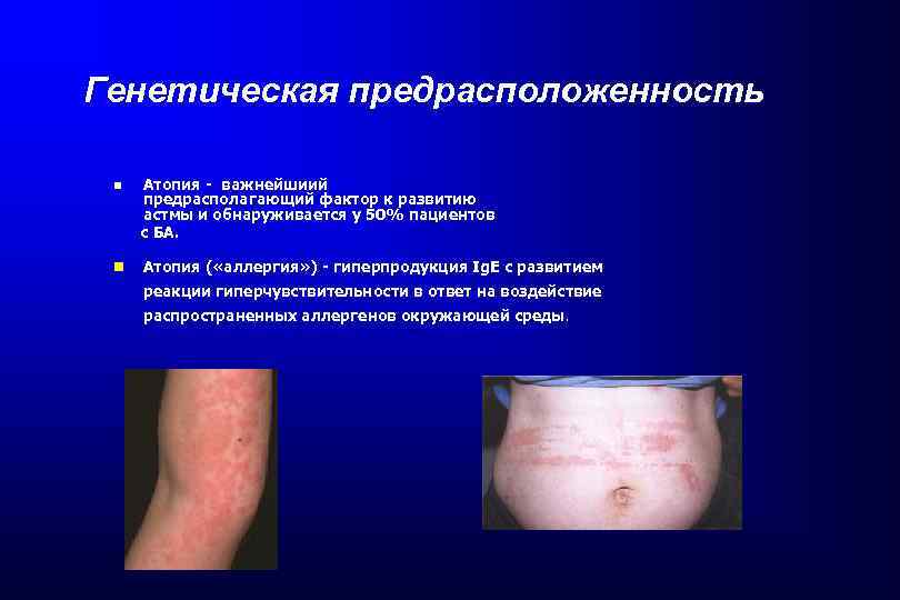 Генетическая предрасположенность Атопия - важнейшиий предрасполагающий фактор к развитию астмы и обнаруживается у 50%