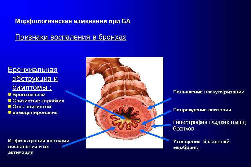 Морфологические изменения при БА Признаки воспаления в бронхах Бронхиальная обструкция и симптомы : l