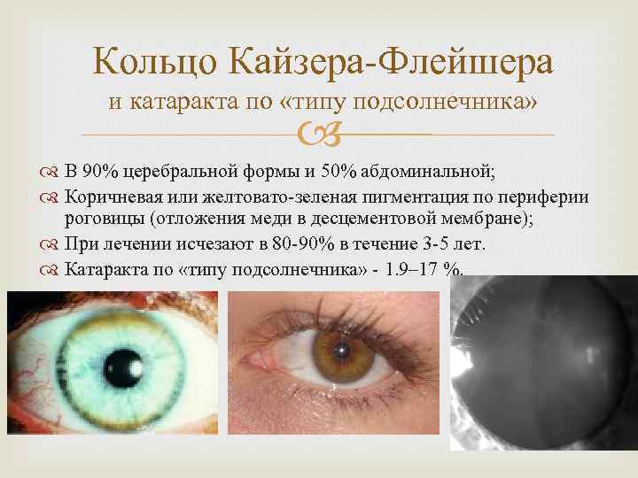 Кольцо Кайзера-Флейшера и катаракта по «типу подсолнечника» В 90% церебральной формы и 50% абдоминальной;