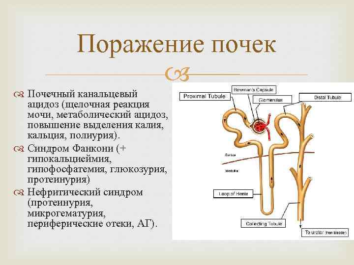 Поражение почек Почечный канальцевый ацидоз (щелочная реакция мочи, метаболический ацидоз, повышение выделения калия, кальция,