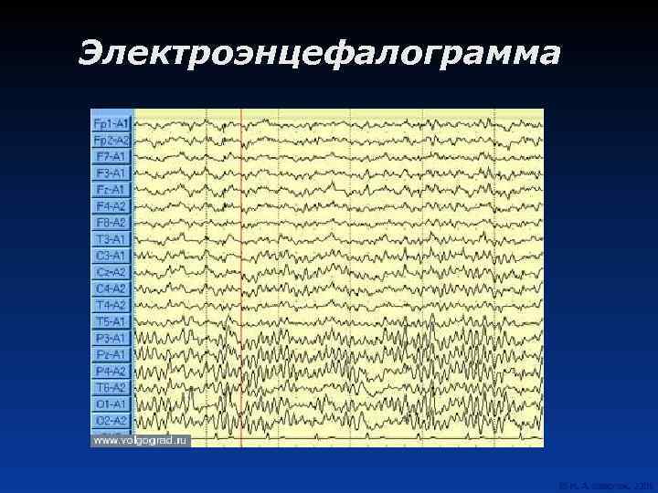 Электроэнцефалограмма 