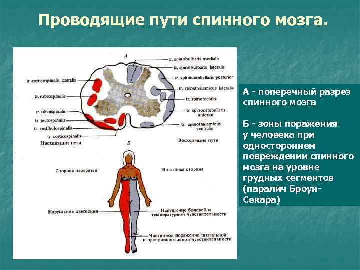 Проводящие пути спинного мозга. А - поперечный разрез спинного мозга Б - зоны поражения