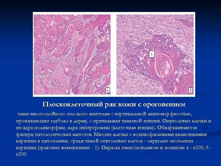 Плоскоклеточный рак кожи с ороговением тяжи многослойного плоского эпителия с вертикальной анизоморфностью, проникающие глубоко