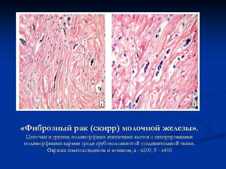  «Фиброзный рак (скирр) молочной железы» . Цепочки и группы полиморфных атипичных клеток с