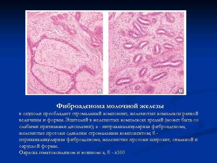 Фиброаденома молочной железы в опухоли преобладает стромальный компонент, железистые комплексы разной величины и формы.