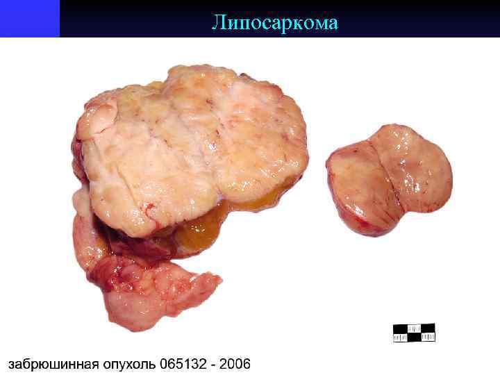 Липосаркома 
