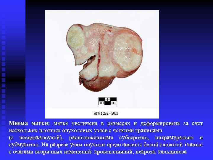 Миома матки: матка увеличена в размерах и деформирована за счет нескольких плотных опухолевых узлов