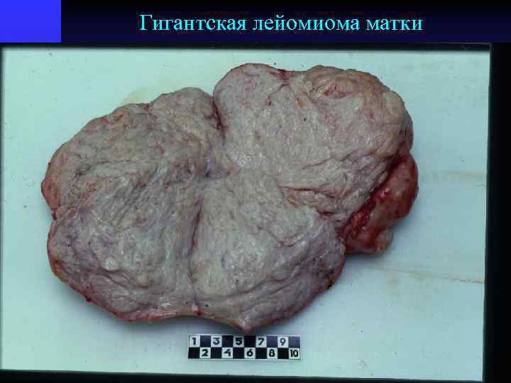 Гигантская лейомиома матки 