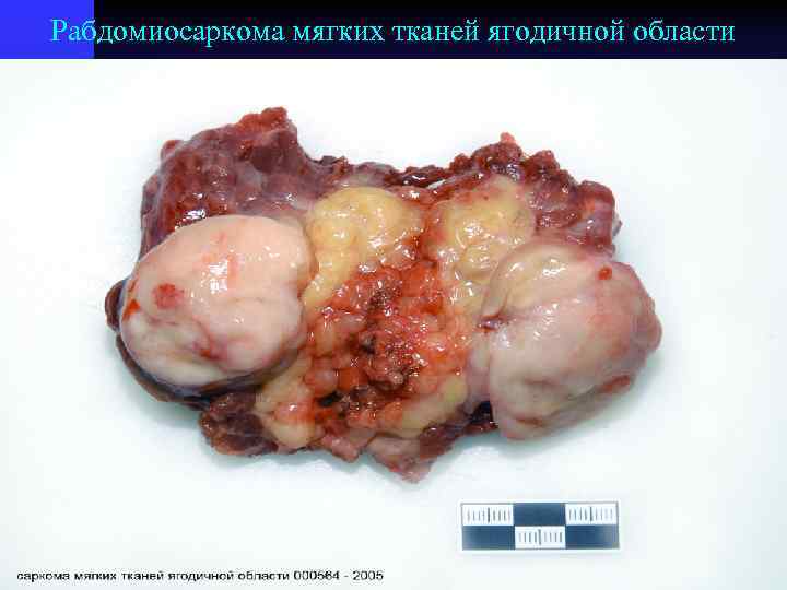 Рабдомиосаркома мягких тканей ягодичной области 