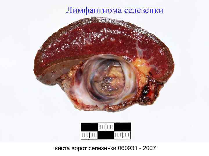 Лимфангиома селезенки 