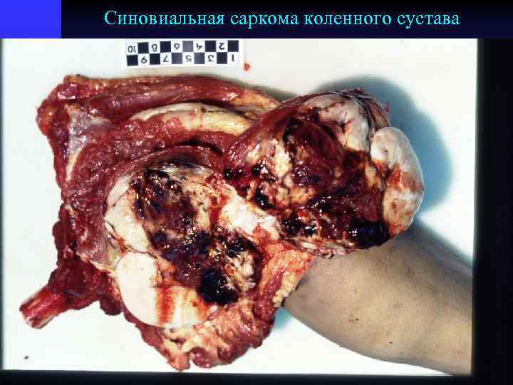 Синовиальная саркома коленного сустава 