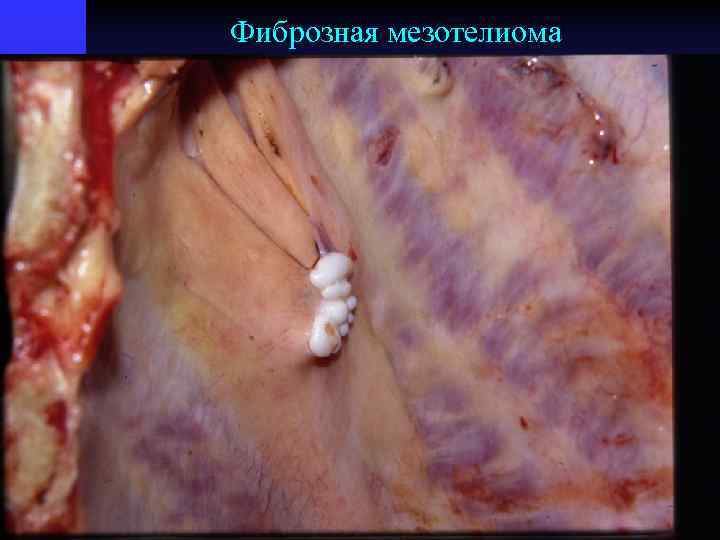 Фиброзная мезотелиома 