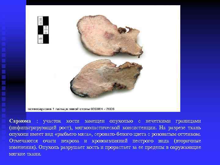 Саркома : участок кости замещен опухолью с нечеткими границами (инфильтрирующий рост), мягкоэластической консистенции. На