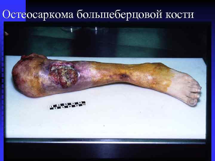 Остеосаркома большеберцовой кости 