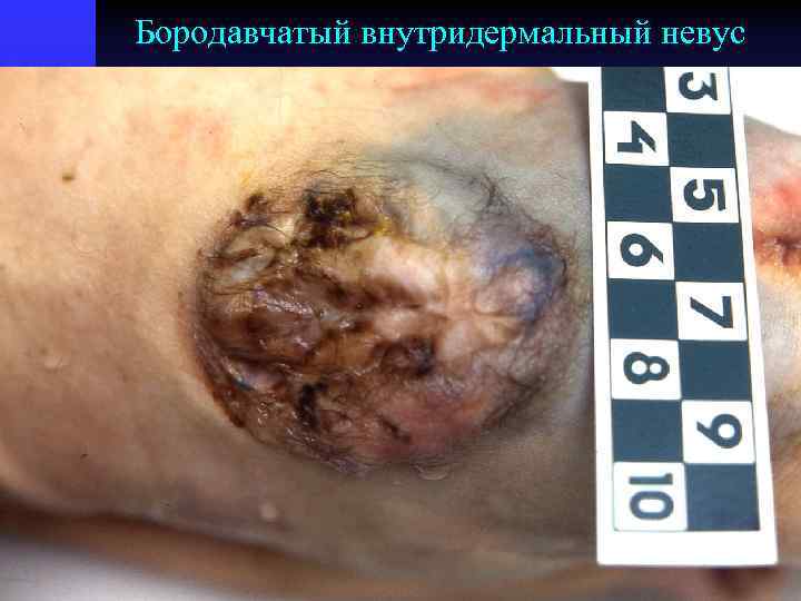 Бородавчатый внутридермальный невус 