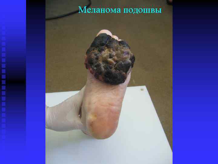 Меланома подошвы 