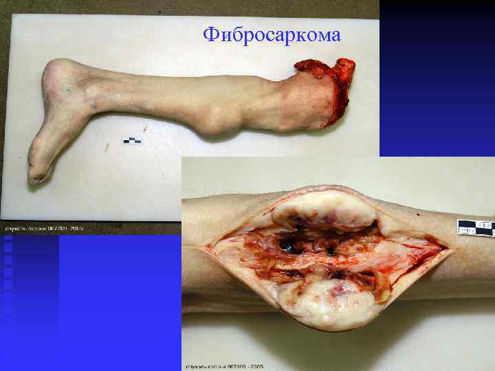 Фибросаркома 