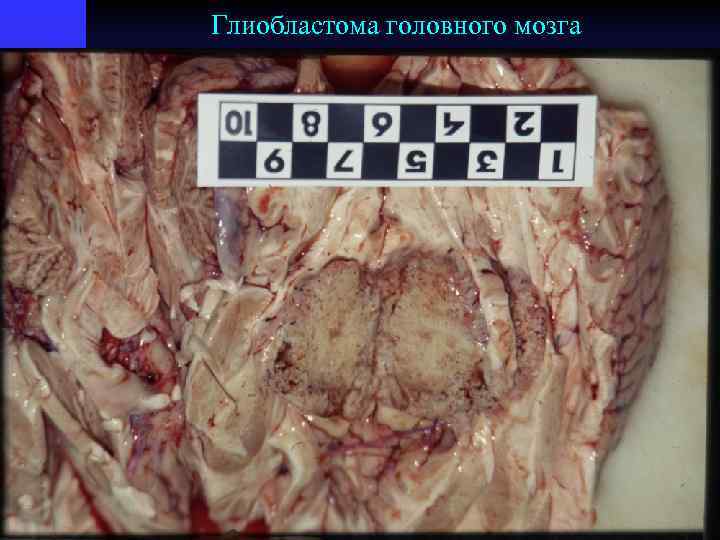 Глиобластома головного мозга 
