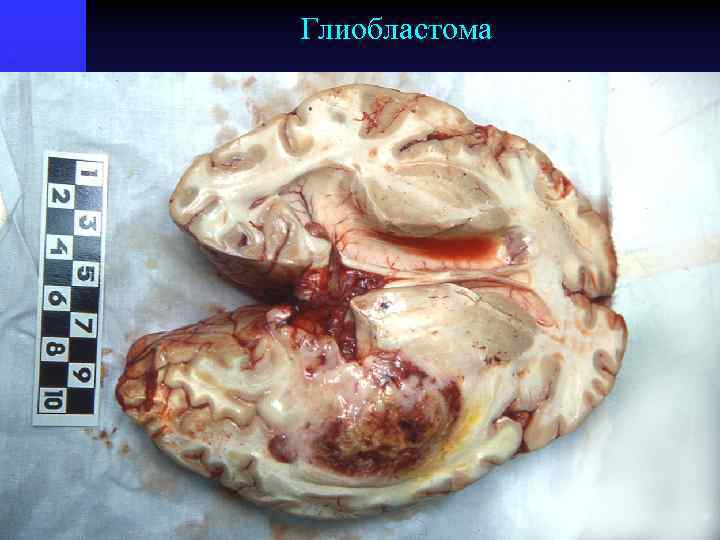 Глиобластома 