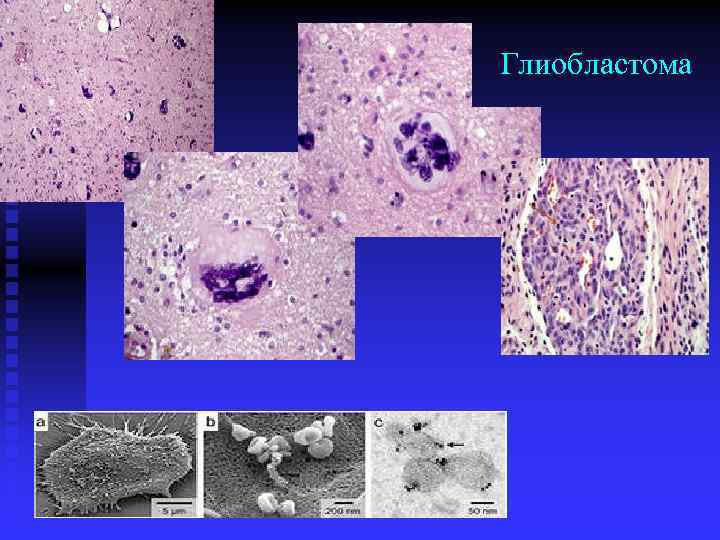 Глиобластома микропрепарат рисунок