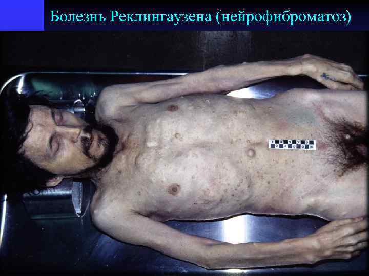 Болезнь Реклингаузена (нейрофиброматоз) 