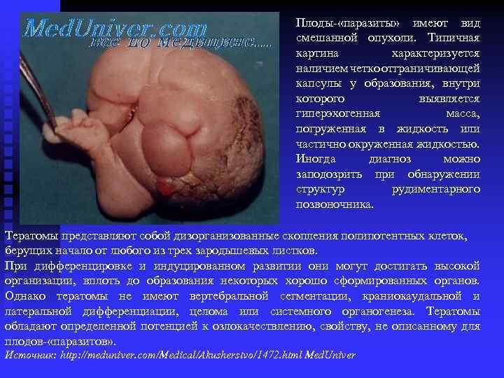 Плоды- «паразиты» имеют вид смешанной опухоли. Типичная картина характеризуется наличием четко отграничивающей капсулы у