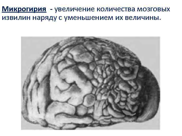 Микрогирия - увеличение количества мозговых извилин наряду с уменьшением их величины. 