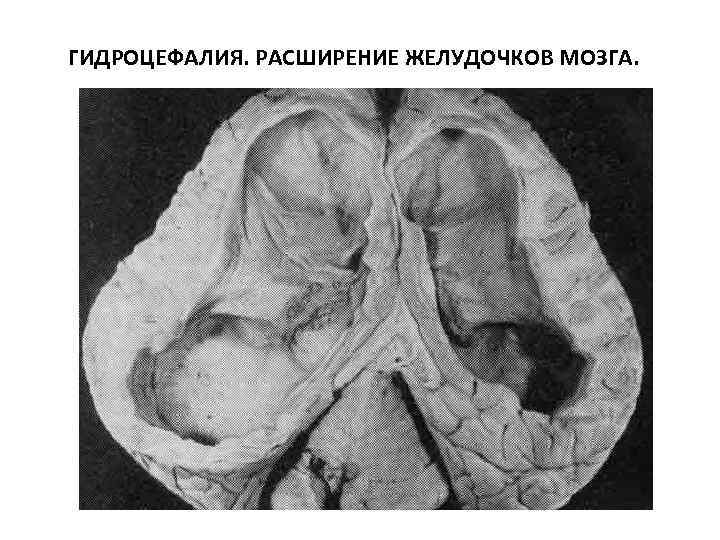 ГИДРОЦЕФАЛИЯ. РАСШИРЕНИЕ ЖЕЛУДОЧКОВ МОЗГА. 