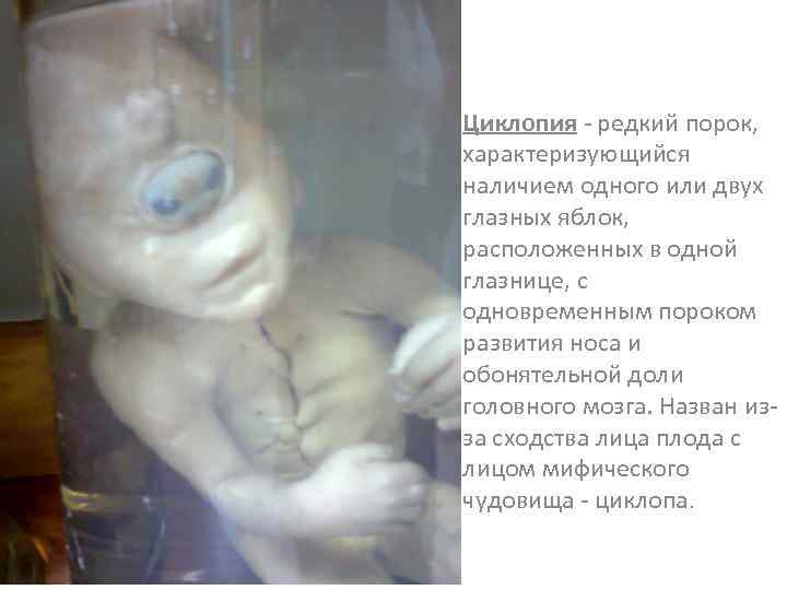 Циклопия - редкий порок, характеризующийся наличием одного или двух глазных яблок, расположенных в одной
