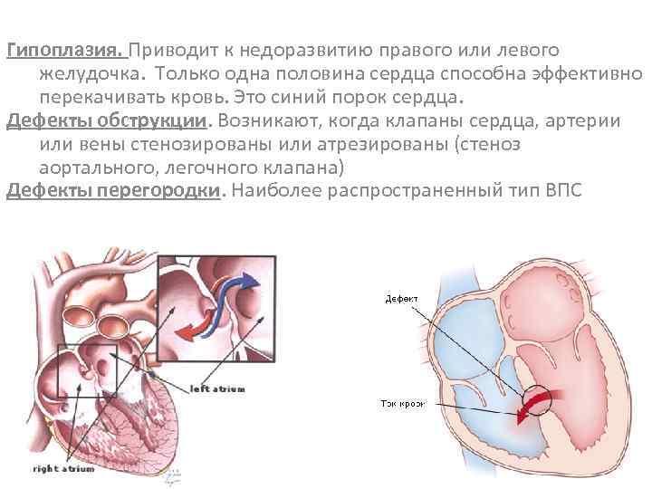 Гипоплазия. Приводит к недоразвитию правого или левого желудочка. Только одна половина сердца способна эффективно