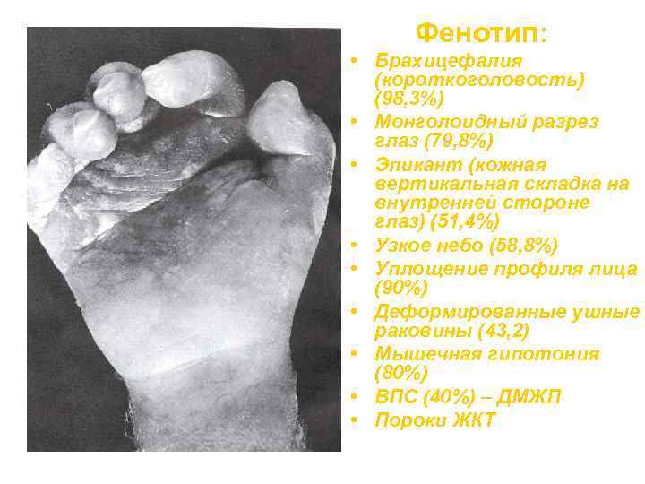 Фенотип: • Брахицефалия (короткоголовость) (98, 3%) • Монголоидный разрез глаз (79, 8%) • Эпикант