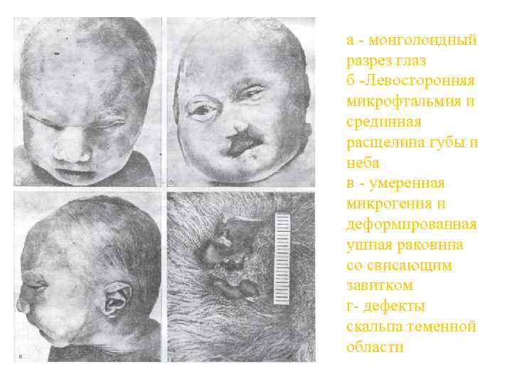 а - монголоидный разрез глаз б -Левосторонняя микрофтальмия и срединная расщелина губы и неба
