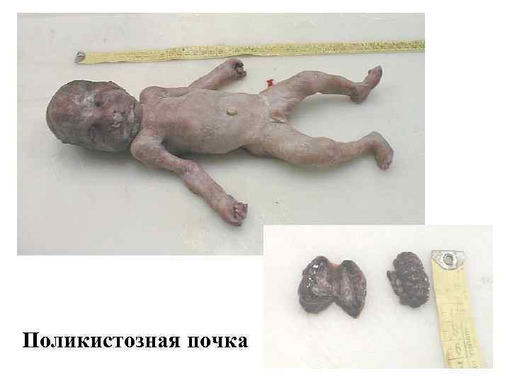 Поликистозная почка 