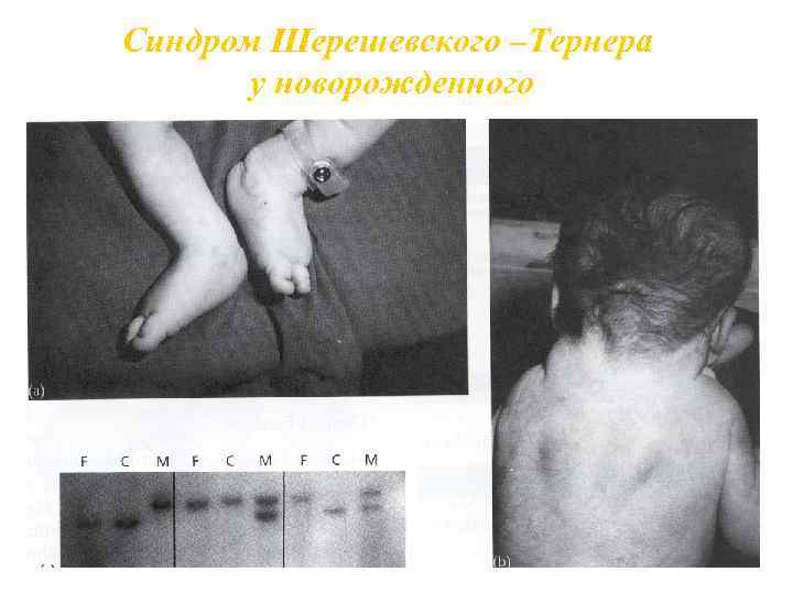 Синдром Шерешевского –Тернера у новорожденного 