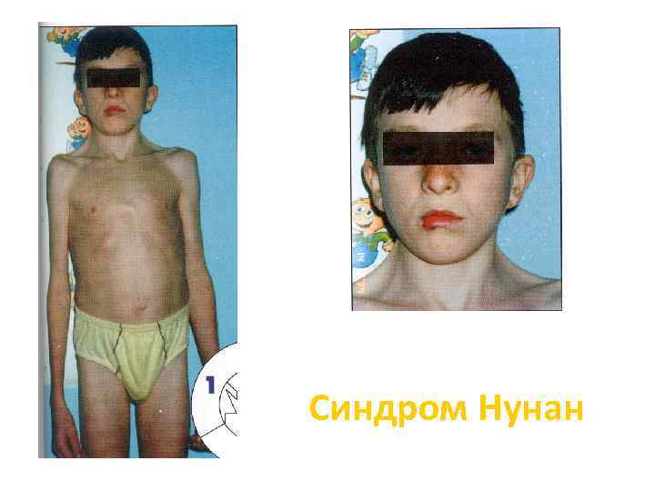 Синдром Нунан 