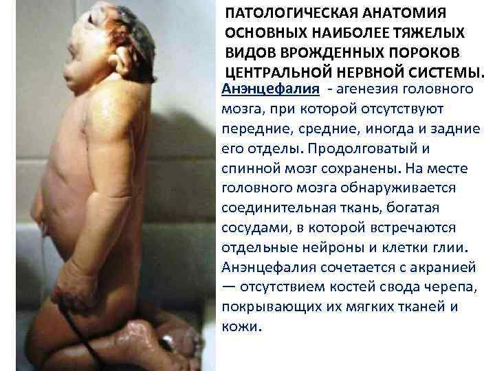 ПАТОЛОГИЧЕСКАЯ АНАТОМИЯ ОСНОВНЫХ НАИБОЛЕЕ ТЯЖЕЛЫХ ВИДОВ ВРОЖДЕННЫХ ПОРОКОВ ЦЕНТРАЛЬНОЙ НЕРВНОЙ СИСТЕМЫ. Анэнцефалия - агенезия
